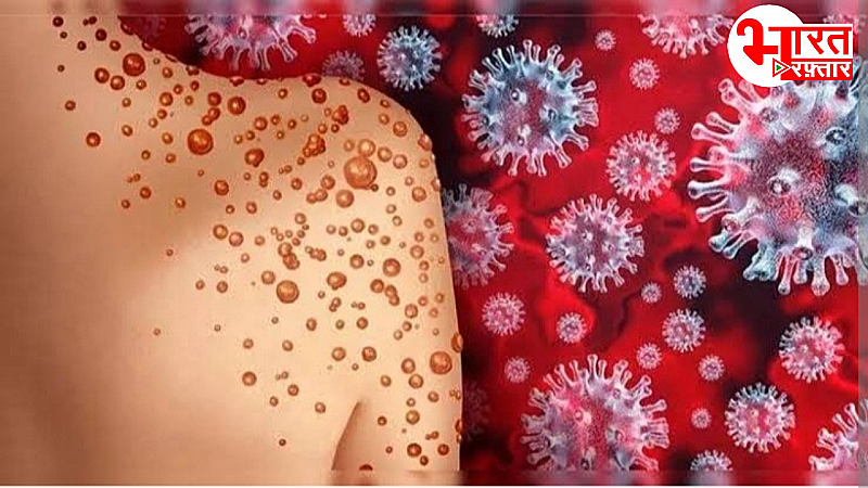 Mpox Virus : भारत समेत 116 देशों में फैला एमपॉक्स का खतरा, क्या बता रहे हैं एक्सपर्ट?